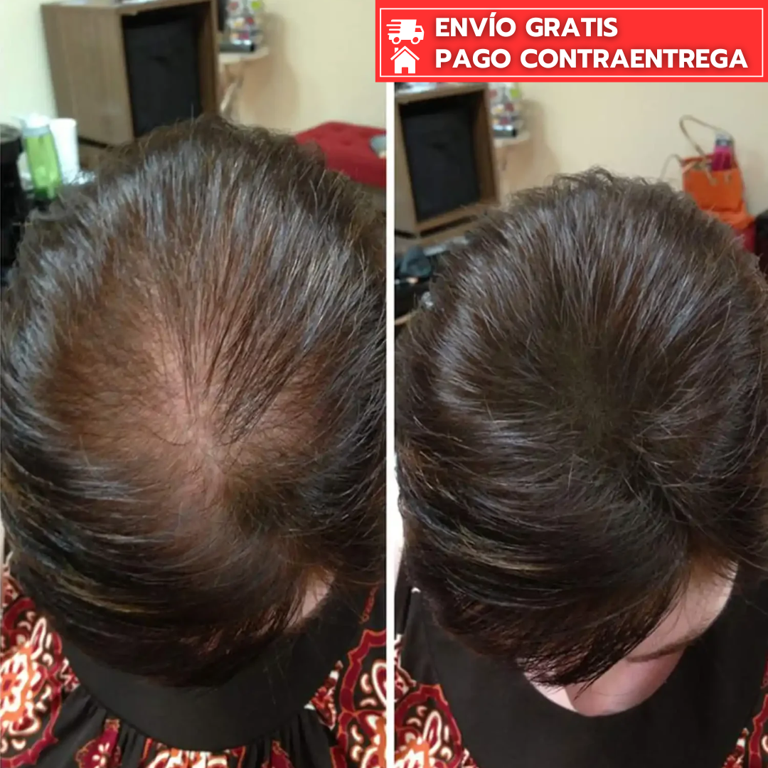 Oferta Especial 2x1: Hair Growth™ - Crece tu cabello 3x veces más rápido naturalmente